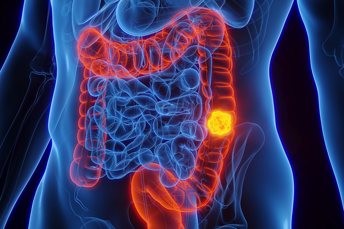 Câncer de intestino: o que é, principais causas e como identificar os sintomas