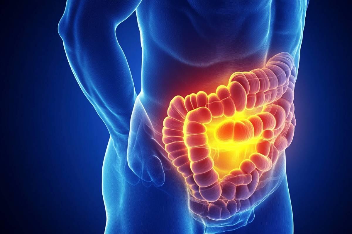 7 Sintomas de Câncer de Intestino Que Você Não Pode Ignorar!