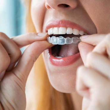 Invisalign em Apucarana / PR