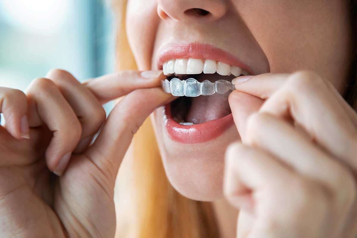 Invisalign em Santa Rosa de Lima / SC