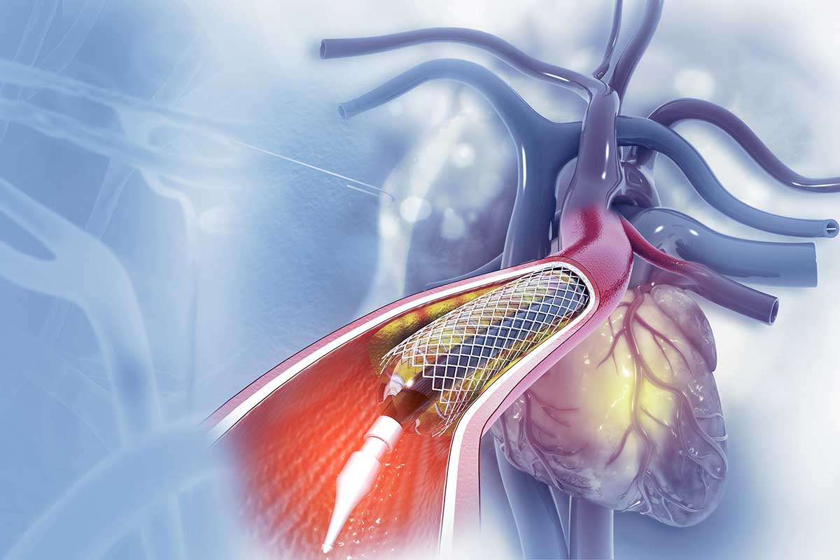 Angioplastia em Pelotas / RS